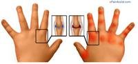 Arthritis, Juvenile Rheumatoid