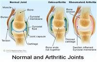 What Causes Rheumatoid Arthritis?