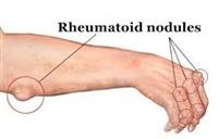 What Are Rheumatoid Nodules?