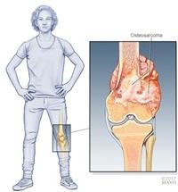 Osteosarcoma Symptoms