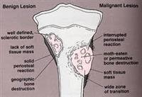 Bone  Tumor s