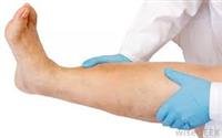 What Is Osteosarcoma?
