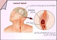 Stroke Treatment