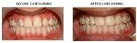The Truth About  Enamel Shaping