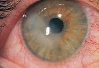 Corneal Flash Burns