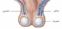 Varicocele treatment,