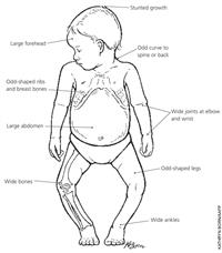 Rickets: What It Is and How It’s Treated
