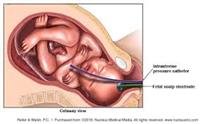 Measuring Babies' Oxygen Level During Labor May Lo