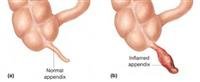Understanding Appendicitis -- Symptoms