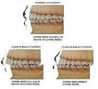 Malocclusion and Orthodontics - Topic Overview