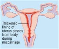 Spontaneous abortion