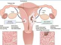 Uterine  Leiomyosarcoma