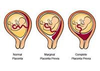 What Is Placenta Previa, and What Are the Symptoms