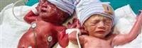 Vomiting blood in newborns