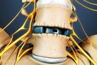 Surgery an Option for Spinal Stenosis