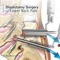 Back Pain Often Ends Without Surgery