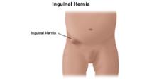 Inguinal Hernia in Children