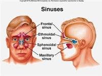 Is It Sinusitis or Allergies?