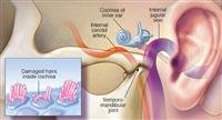 Tinnitus Symptoms