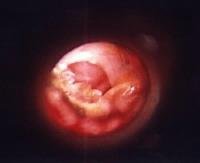 Perforated Eardrum