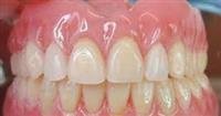Gingivitis.