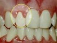 What is gum disease (gingivitis)?