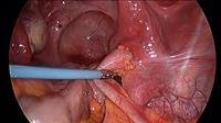 Surgery for Endometriosis