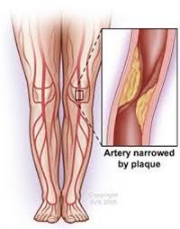 What Is Vascular Disease?