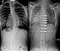 Surgery for Scoliosis