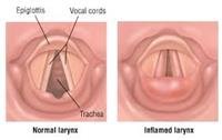 What causes spasmodic croup?