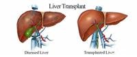 Liver transplant...