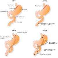 Gastric Bypass Surgery Has Risks
