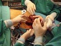 Organ Transplantation