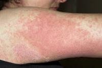 Medicines That May Cause a Rash in Children