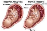 What Is Placental  Abruption?