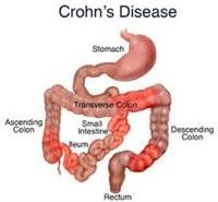 How Fiber Affects Crohn’s Disease