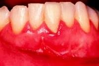 Gum Problem Basics: Sore Swollen, and Bleeding Gu