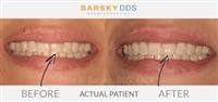 Repairing a  Chipped or  Broken Tooth