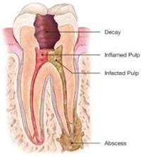 An Overview  of Root Canals.
