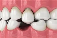 5 Tooth Replacement Options