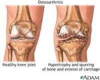 Osteoarthritis