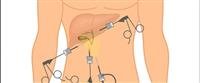 Gallbladder removal Complications