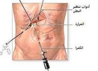 استئصال المرارة بالمنظار
