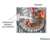 Gastric Suction (Stomach Pumping)