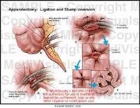 Appendectomy