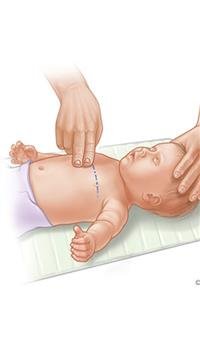 CPR for Infants  (Age <1)