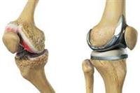 Hip replacement.
