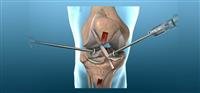 Anterior Cruciate Ligament (ACL) Surgery
