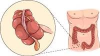 Laparoscopic appendectomy.