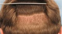 Natural hair transplantation